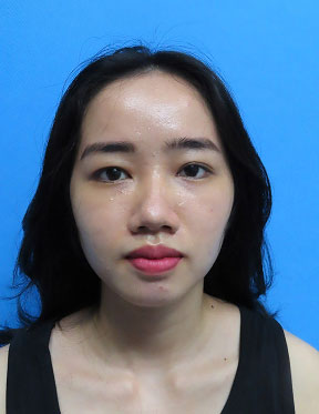 Trước sau cắt cánh mũi 1