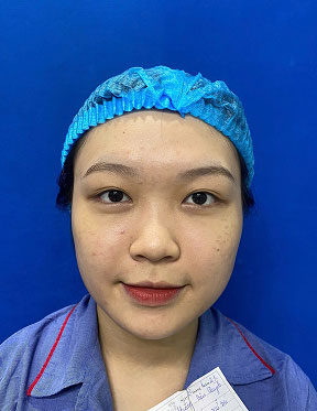 Trước sau cắt cánh mũi 3