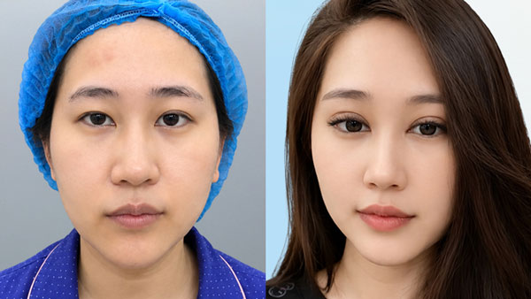 Trước sau chỉnh hình sụp mí bẩm sinh khách hàng Hương Quỳnh tại Kangnam