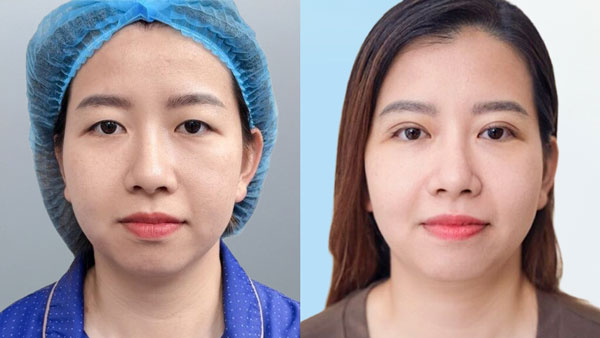 Trước sau chỉnh sụp mí bẩm sinh khách hàng Hồng Thủy tại Kangnam