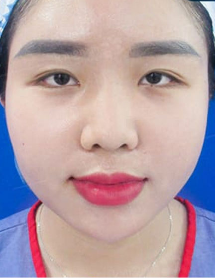 Trước sau cắt cánh mũi 1