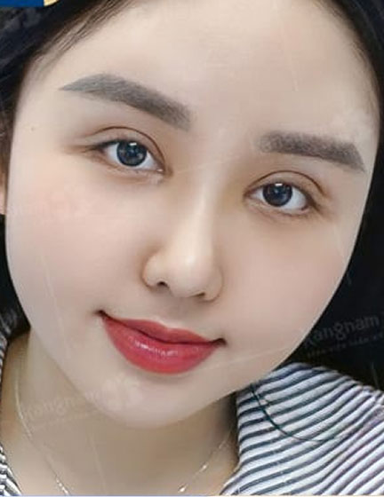 Trước sau cắt cánh mũi 2
