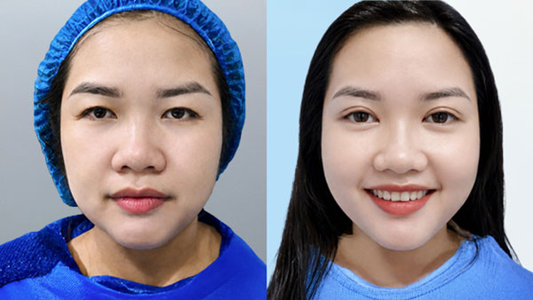 Trước sau cắt mí tạo khóe mắt trong khách hàng Thúy Vân tại Kangnam