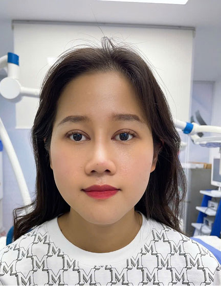 Trước sau cắt cánh mũi 2
