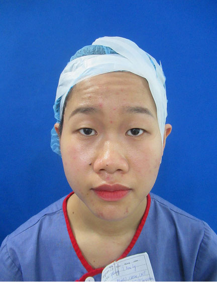 Trước sau cắt cánh mũi 3