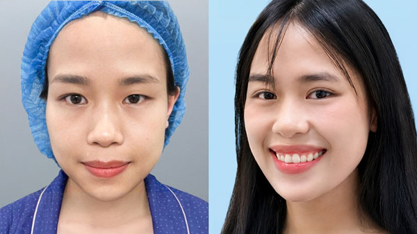 Trước sau cắt mí mắt 1 mí khách hàng Thanh Trang tại Kangnam