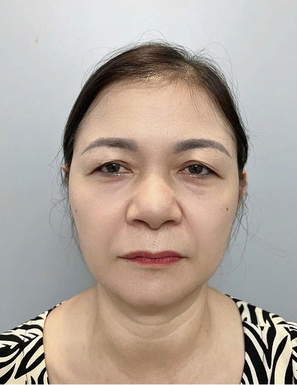 Trước sau cắt cánh mũi 1