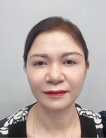 Trước sau cắt cánh mũi 2