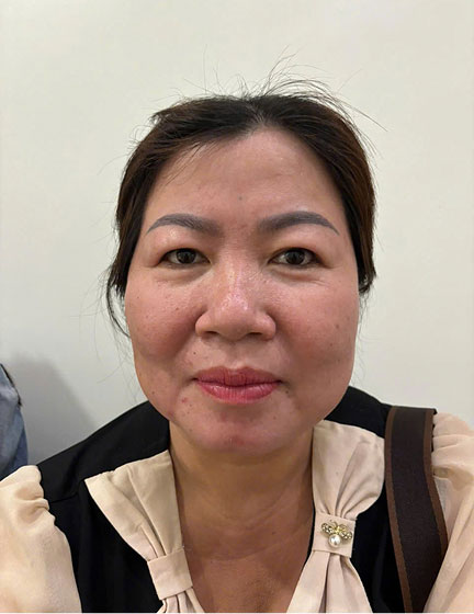 Trước sau cắt cánh mũi 3