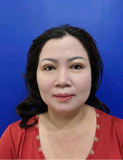 Trước sau cắt cánh mũi 4