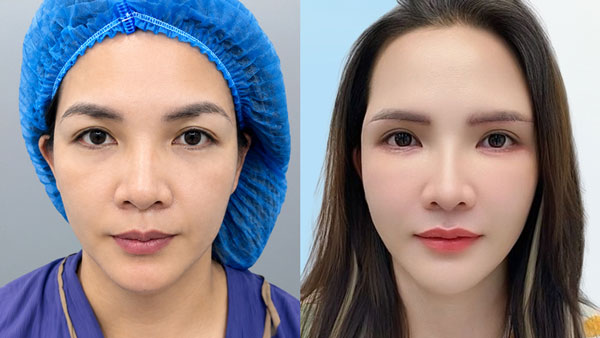 Trước sau nâng cung mày cắt bọng mỡ khách hàng Ngọc Vân tại Kangnam