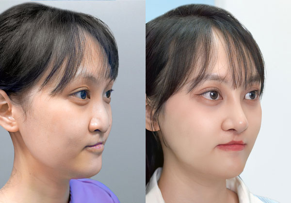 Trước sau khắc phục mũi lệch vẹo lộ sóng tại Kangnam
