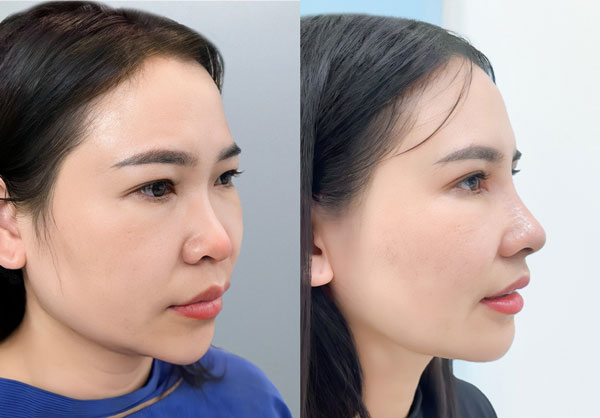 Trước sau khắc phục đầu mũi bóng đỏ tại Kangnam