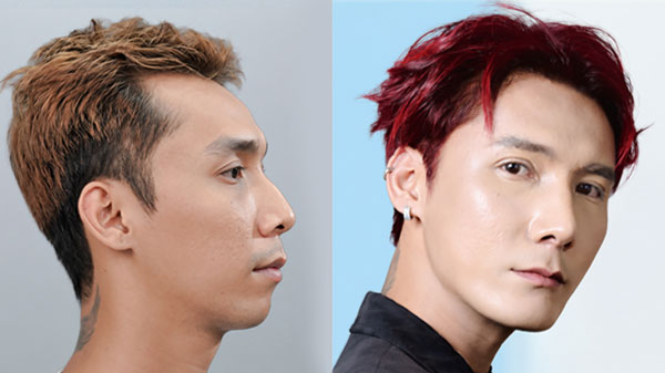 Trước và sau mài gồ kết hợp tái cấu trúc mũi của thí sinh Chí Nguyện - Hành trình Lột Xác mùa 7 tại Kangnam