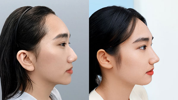 Trước và sau combo nâng mũi Idol kết hợp mài gồ xương của khách hàng Minh Châu tại Bệnh viện Thẩm mỹ Kangnam