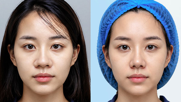 Trước và sau cuộn cánh mũi giấu sẹo của khách hàng Thu Trang tại Kangnam