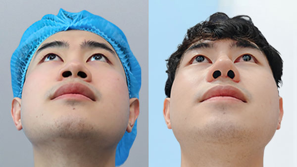 Trước và sau cắt cánh mũi của khách hàng Hoàng Nam tại Kangnam