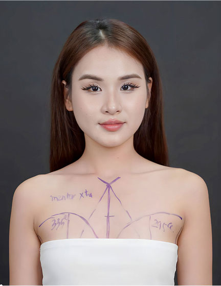 Trước sau cắt cánh mũi 1