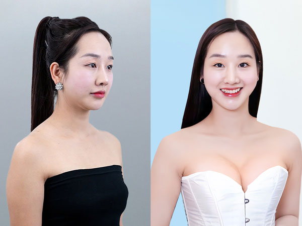 Trước và sau nâng ngực cô giáo Hà Duyên tại Kangnam