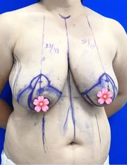 Trước sau cắt cánh mũi 1