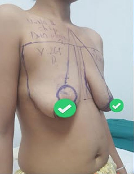 Trước sau cắt cánh mũi 3