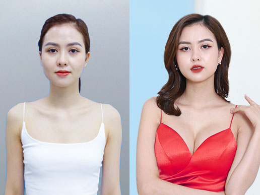 Khách hàng Huyền Giang nâng ngực đặt túi tại Kangnam