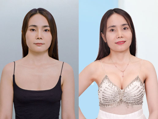 Khách hàng Thúy Nguyễn nâng ngực 6D không chạm đặt túi tại Kangnam Sài Gòn