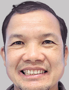 Trước sau cắt cánh mũi 1