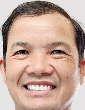 Trước sau cắt cánh mũi 2