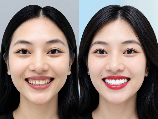 Bọc răng sứ thẩm mỹ cải thiện răng nhiễm màu tại Kangnam