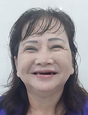 Trước sau cắt cánh mũi 3