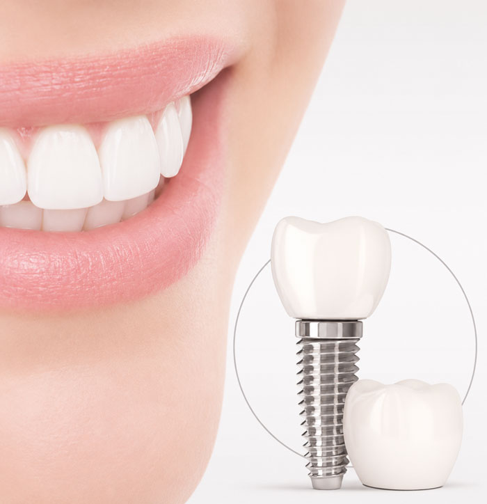 Cấy Implant