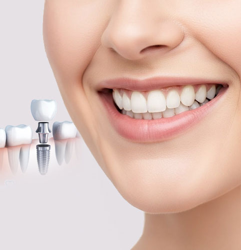 Cấy ghép Implant phục hồi răng đã mất tại Kangnam