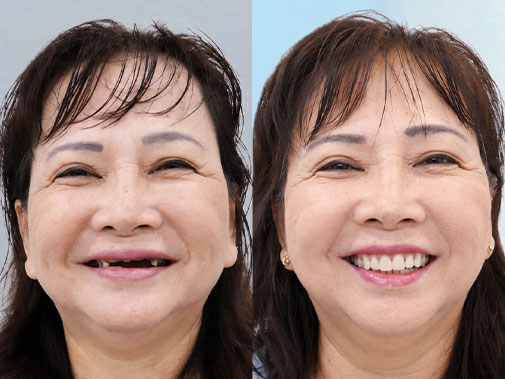 Cấy ghép Implant phục hồi nhiều răng đã mất tại Kangnam