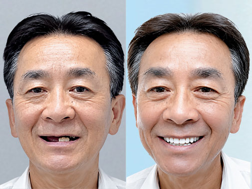 Cấy ghép Implant toàn hàm dưới phục hồi nhiều răng đã mất tại Kangnam
