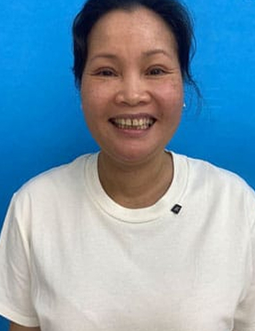 Trước sau cắt cánh mũi 1