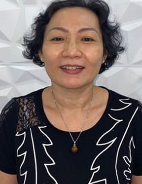 Trước sau cắt cánh mũi 3