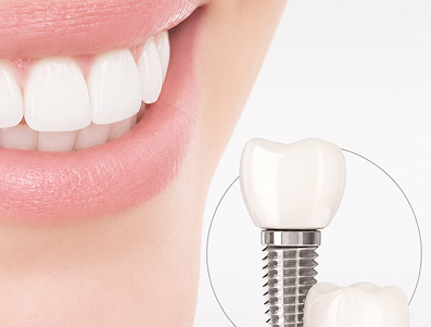 cấy implant