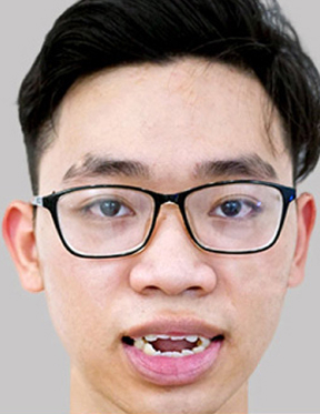 Trước sau cắt cánh mũi 1