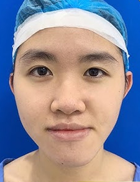 Trước sau cắt cánh mũi 3
