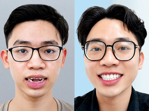 Khách hàng Nguyễn Văn Nam niềng răng tại BVTM Kangnam