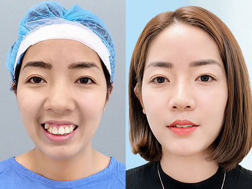 Khách hàng Phạm Khánh Linh niềng răng tại BVTM Kangnam