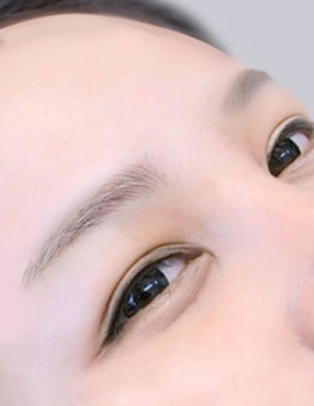 Trước sau cắt cánh mũi 1