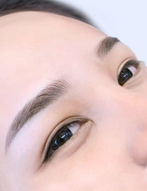 Trước sau cắt cánh mũi 2