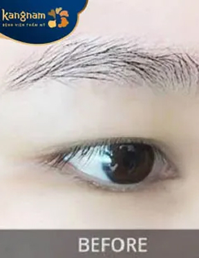 Trước sau cắt cánh mũi 3