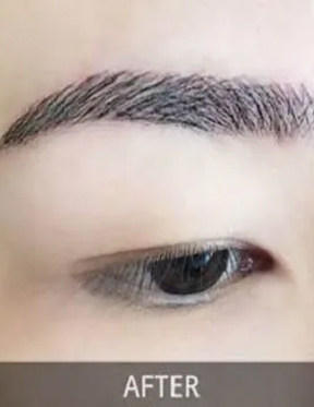 Trước sau cắt cánh mũi 4