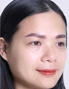 Trước sau cắt cánh mũi 2