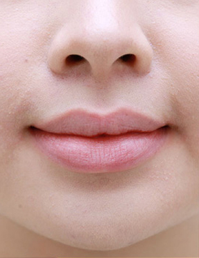 Trước sau cắt cánh mũi 3