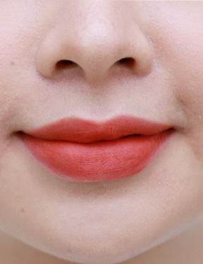 Trước sau cắt cánh mũi 4