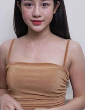 Trước sau cắt cánh mũi 1